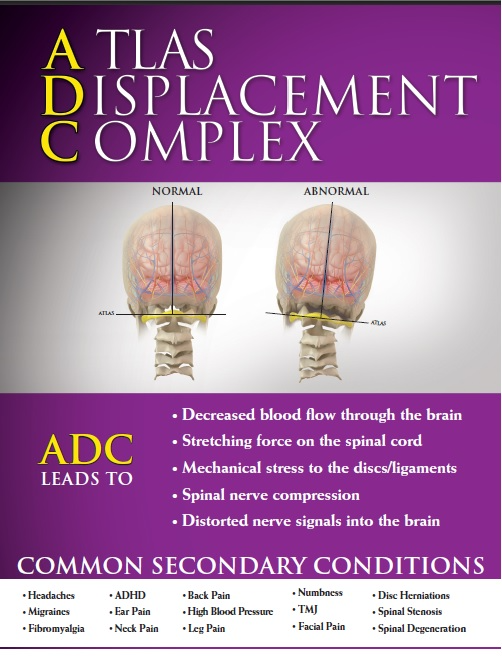 Atlas Displacement Complex (ADC)