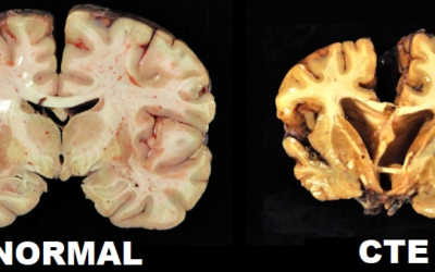 The NFL & CTE — What Can Foundational Correction Do?