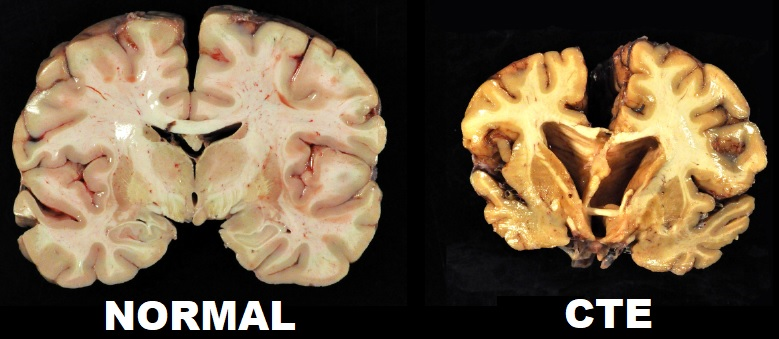 nfl and cte brain damage