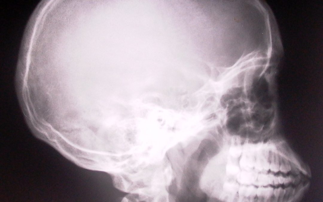 xray skull