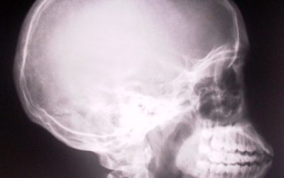 Why Do Foundational Chiropractors Take Xrays?